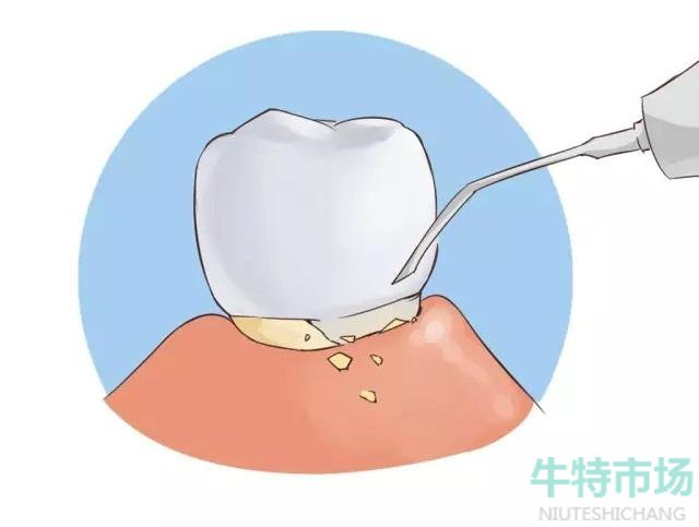 支付宝洗牙会把牙齿的牙釉质洗掉吗